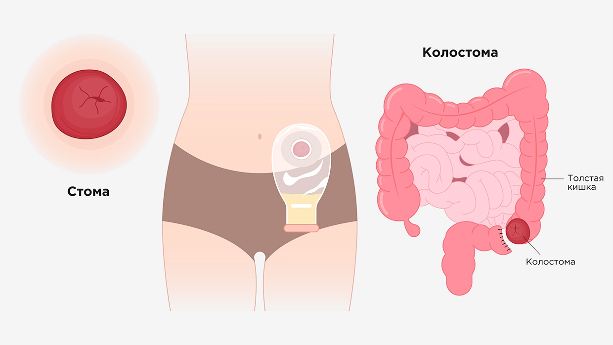 Закрытие колостомы: как проходит операция и каков прогноз?